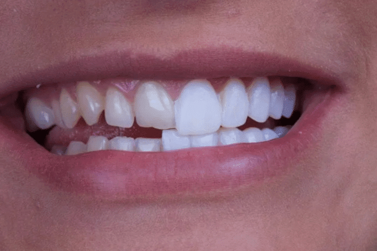 Veneers