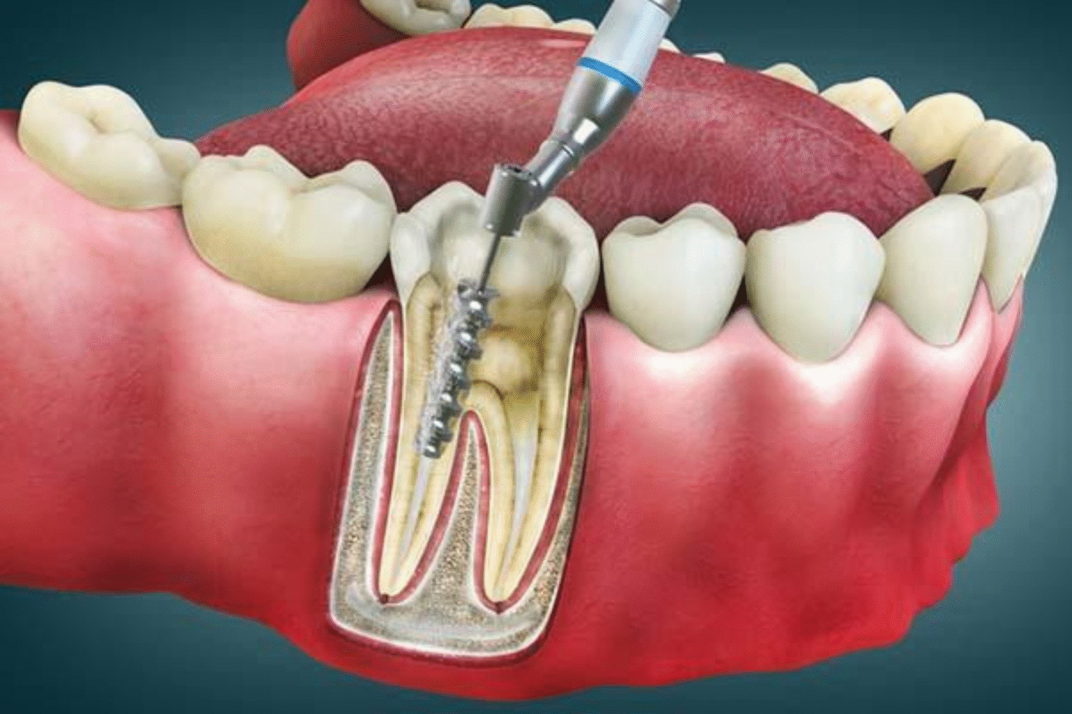 Root Canal Treatment